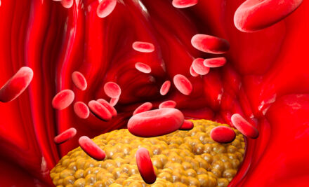 Por que devemos monitorar os níveis de Triglicerídeos?