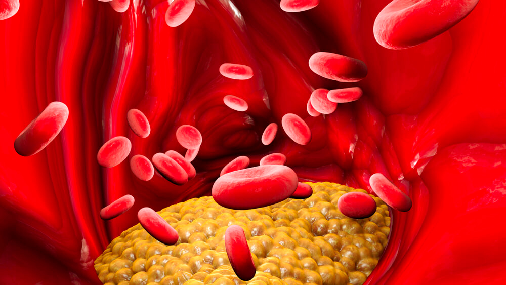 Por que devemos monitorar os níveis de Triglicerídeos?