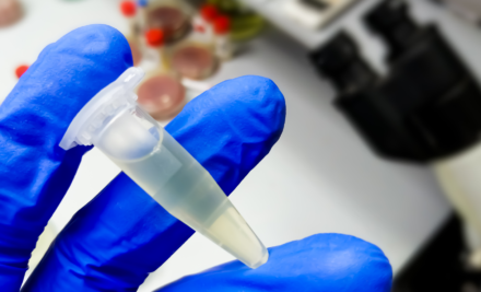 O exame que identifica o HPV e seus riscos: Captura híbrida de baixo e alto risco